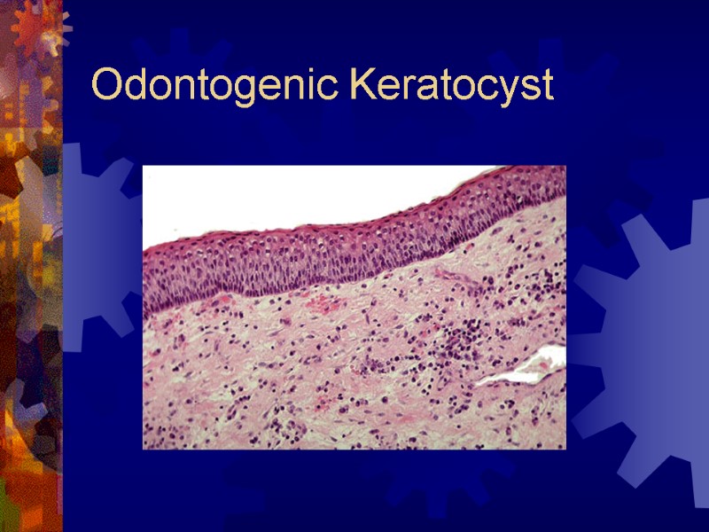 Odontogenic Keratocyst